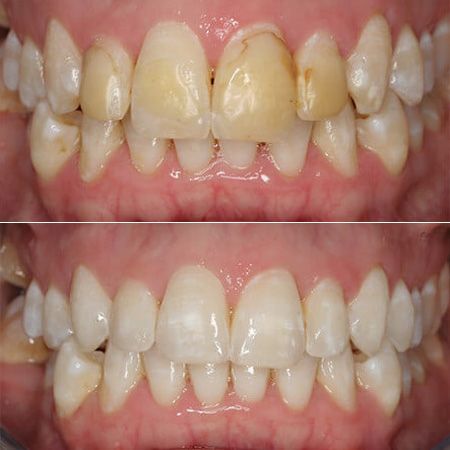 Зачем снимать зубные отложения